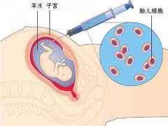 羊水穿刺亲子鉴定详解：原理、准确性及潜在风险